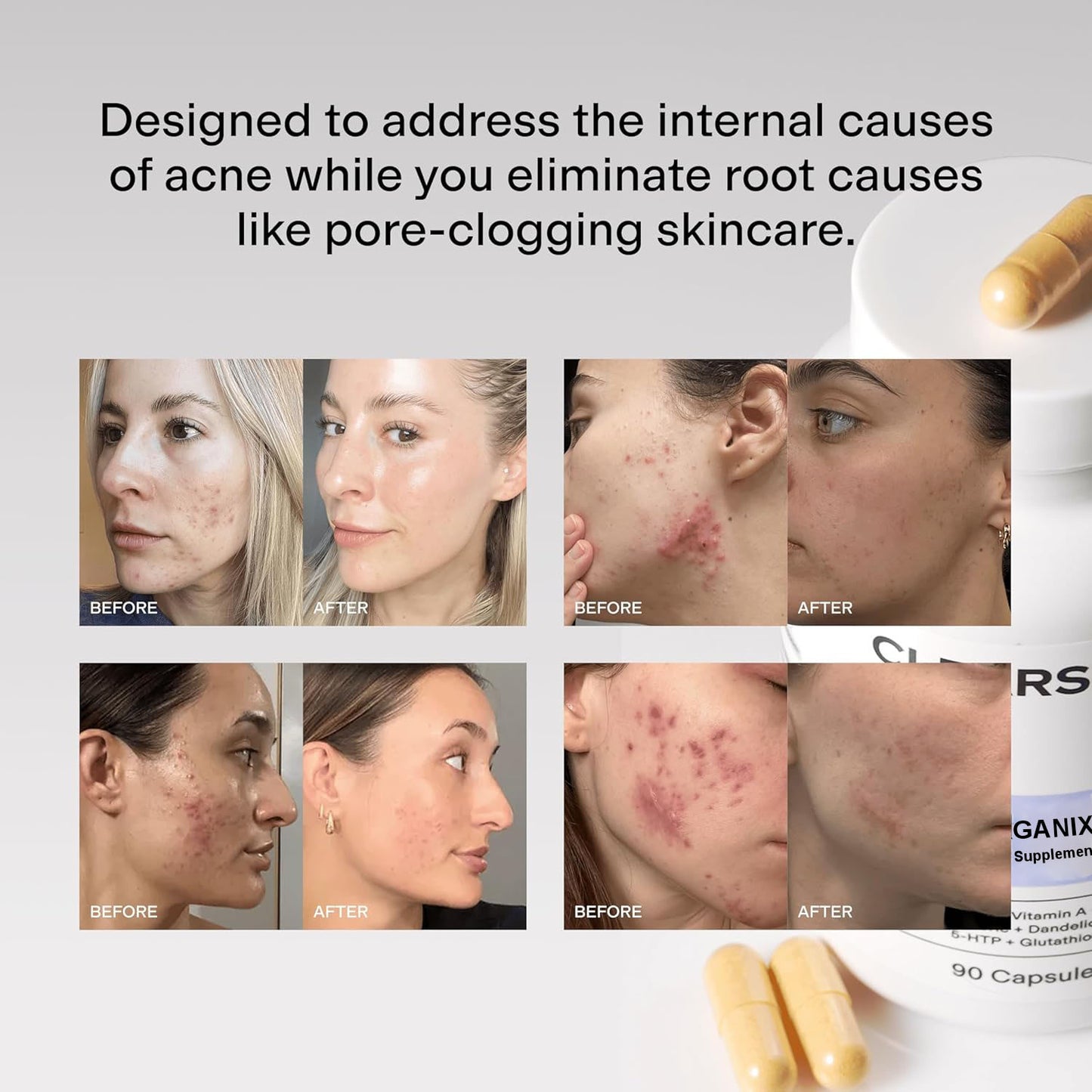 Buy 1 Get 1 Free - Organix™ - Hormonal Acne Supplement